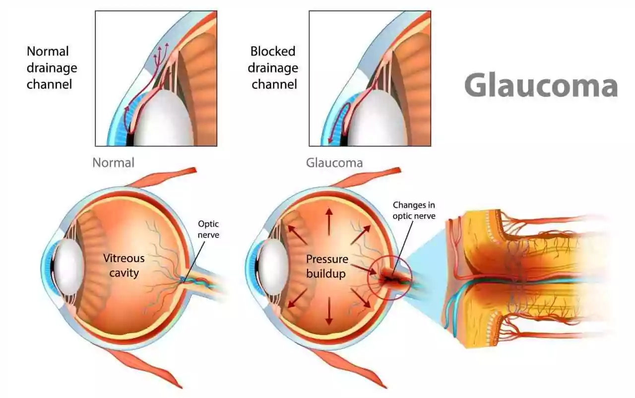 Glaucoma diagram showing how increased intraocular pressure harms vision and can lead to blindness.