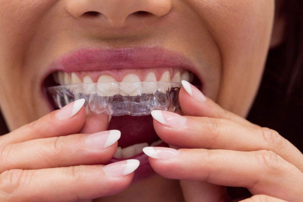 Woman putting in an Invisalign.