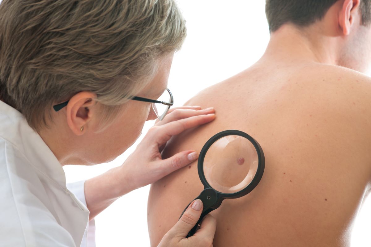 Doctor examining a mole on a patient's back to check for skin cancer.